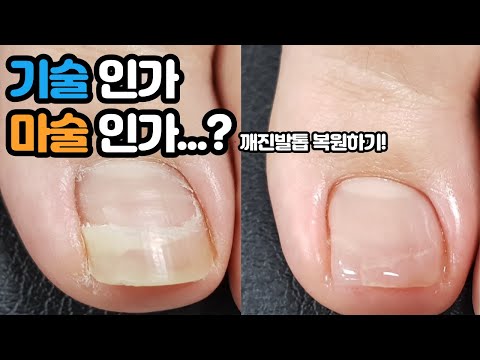 [대구발톱복원]이것은 기술인가 마술인가? 깨진발톱 복원하기 두둥! Restoring cracked toenail