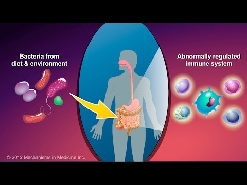 What is Crohn's Disease?