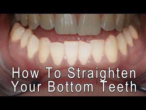 Dental Braces - How to Straighten your bottom front teeth